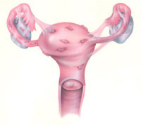 Лечение эндометриоза шейки матки в гинекологическом отделении &amp;amp;laquo;Клиники ABC&amp;amp;raquo