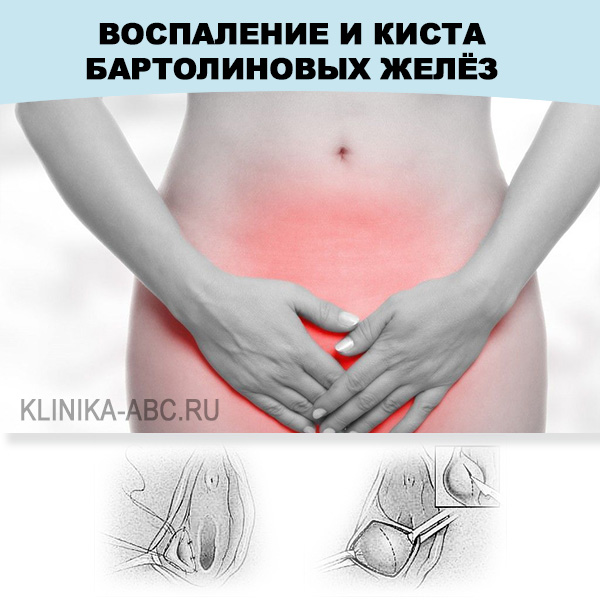 Лечение кисты бартолиновой железы в Ростове-на-Дону