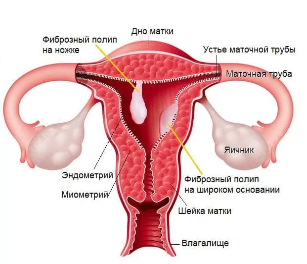 Полипы матки: симптомы, лечение (удаление)