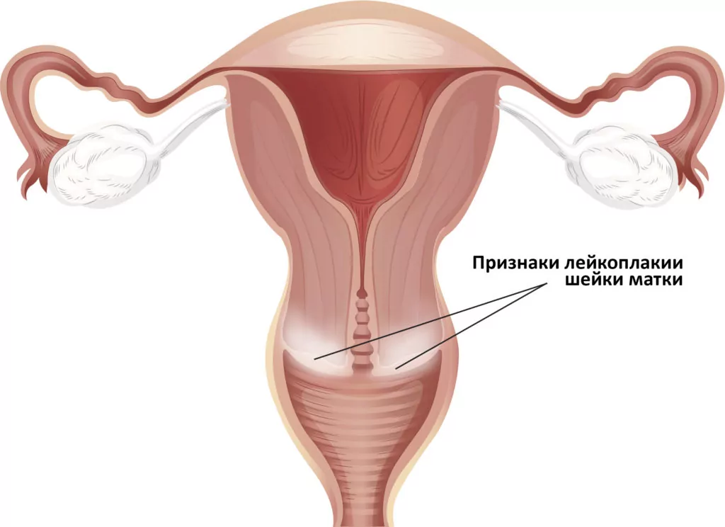 Лейкоплакия шейки матки