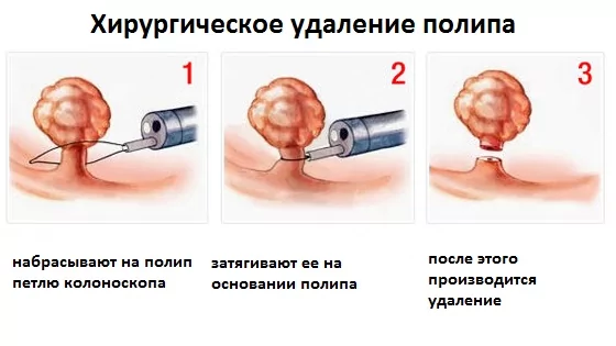 Лечение фурункула и карбункула – лечение в Москве в клинике доктора Назимовой